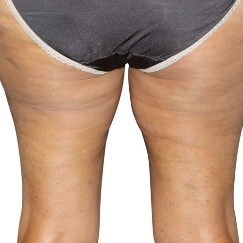 Cellulite Buttocks